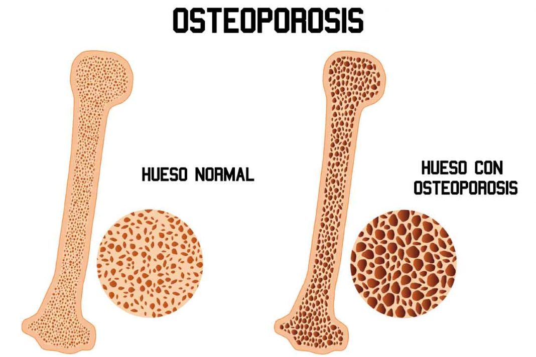 Consejos Útiles para Cuidar los Huesos del Corredor Escuela de Running Consejos Útiles para Cuidar los Huesos del Corredor Escuela de Running